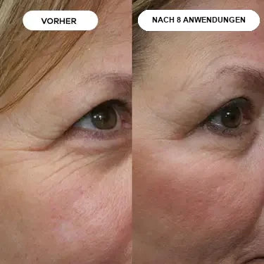Stoppt Faltenbildung an der Ursache